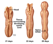 Ilustración del desarrollo del conducto neural y de la espina bífida