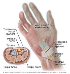 Ilustración del dolor de la mano