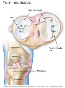 medical illustration of a torn meniscus
