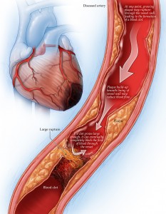 coronary artery disease illustration