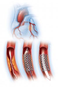coronary artery illustration with mesh