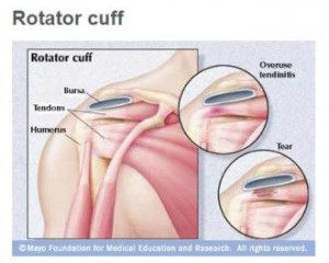 Ilustración médica del manguito rotador