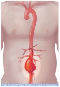 Ilustración de aneurismas aórticos abdominales