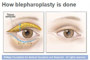 Ilustración médica sobre cómo se realiza la blefaroplastia en los ojos.