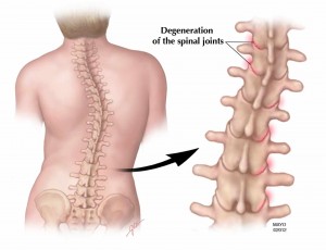 image showing degeneration of the spinal joints