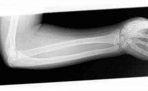 Distal-Forearm-Fracture1