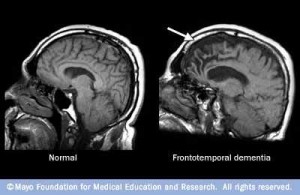 Exploraciones por resonancia magnética que muestran un cerebro normal y otro con demencia frontotemporal.