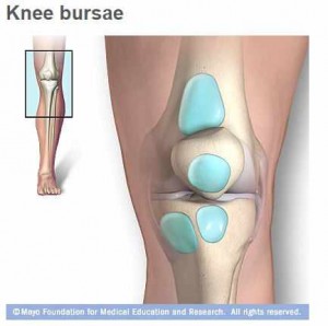 Ilustración médica de la bursitis de la rodilla con sacos llenos de líquido