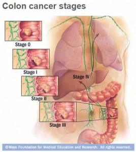 illustration of colon cancer stages