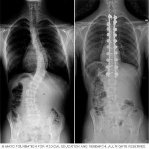 ex-ray scan showing scoliosis 