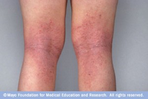 skin rash and eczema on legs