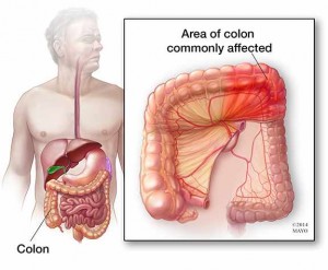 illustration of abdomin highlighting colon and ischemic colitis
