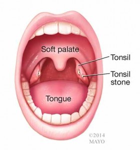 illustration of mouth with tonsil stones - tonsollith