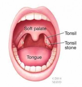 Ilustración de una boca con cálculos amigdalinos