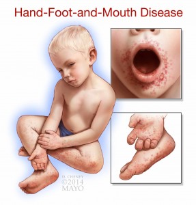 illustration of little boy with hand foot and mouth disease