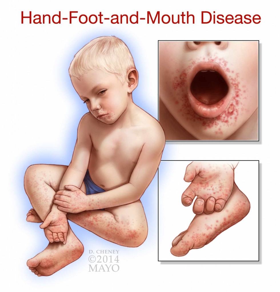 what-are-the-best-ways-to-treat-a-toddler-with-hand-foot-and-mouth