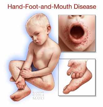 Ilustración de un niño pequeño con la enfermedad de manos, pies y boca