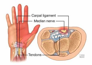 illustration of hand with carpal tunnel