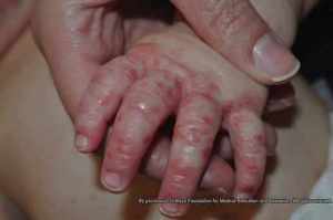 La mano de un niño muestra la enfermedad de manos, pies y boca