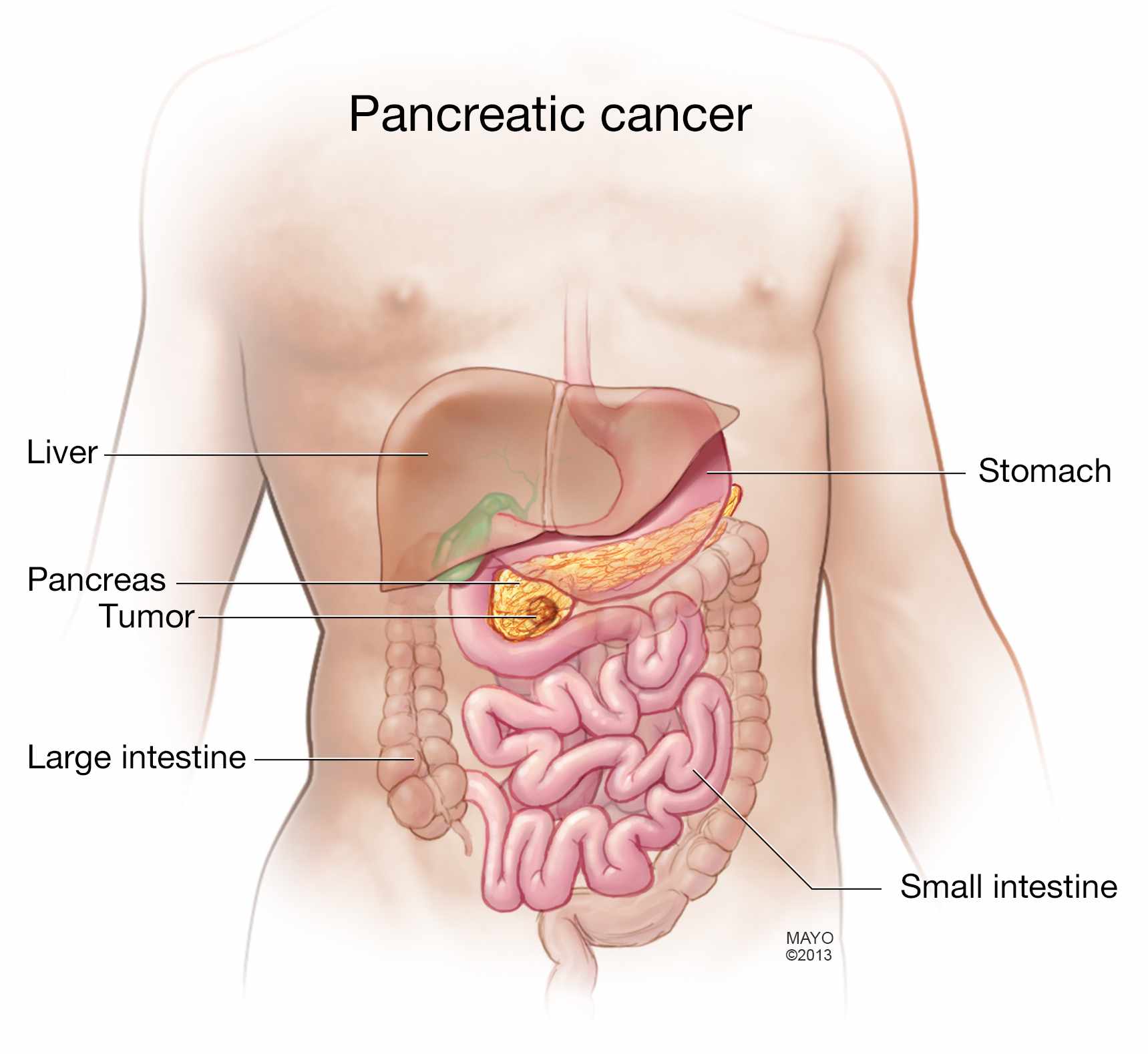 illustration of pancreatic cancer and related anatomy