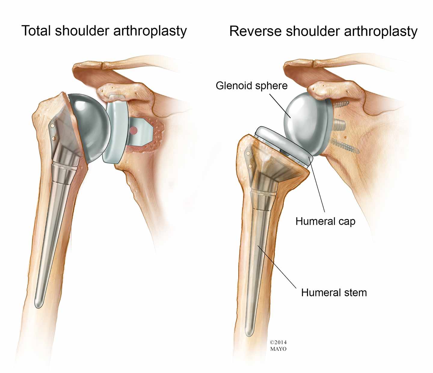 tuesday-q-and-a-reverse-shoulder-arthroplasty-may-be-best-option-for