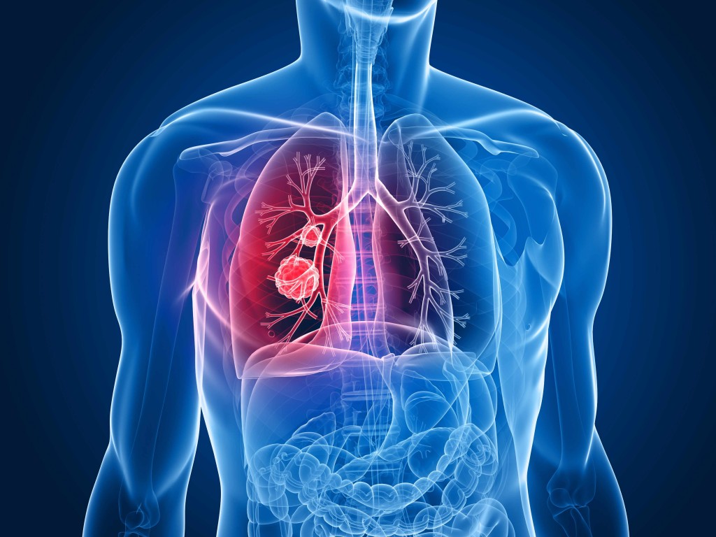 illustration showing chest, lungs and cancer tumor