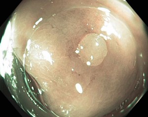 The benign hyperplastic polyp appears very pale and bland on imaging.
