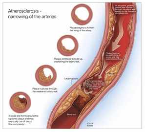 Ilustración del estrechamiento de las arterias por la ateroesclerosis