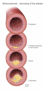 sideview illustration atherosclerosis narrowing of the arteries