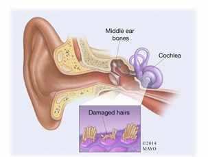 Ilustración del oído y descripción de la pérdida auditiva