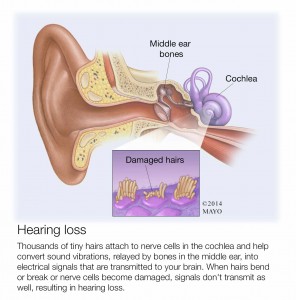 illustration or ear and dscription of hearing loss