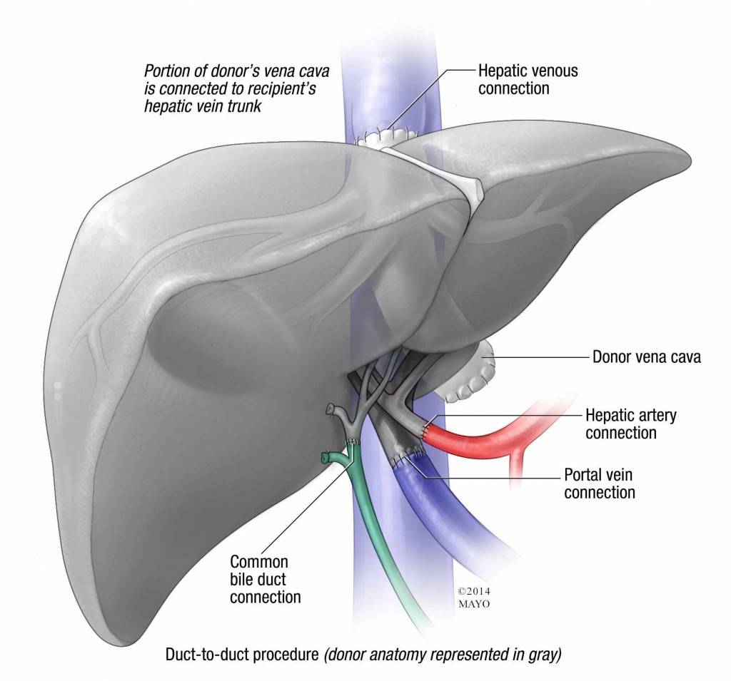 illustration of liver transplant duct-to-duct procedure
