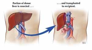 Ilustración de un trasplante de hígado de donante vivo