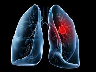 Ilustración de los pulmones con un tumor canceroso