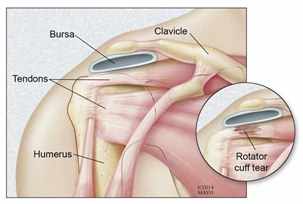 Ilustración de la anatomía del desgarre del manguito de rotadores en el hombro