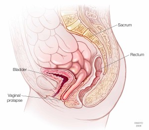 illustration of vaginal prolapse