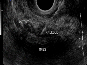 The image shows a pancreas tumor being biopsied with a needle as visualized by endoscopic ultrasound. The endoscope was located within the stomach (passed via the mouth). An ultrasound probe at the tip of the endoscope allows visualization of the pancreas which is located immediately next to the stomach. A long needle is guided through the endoscope and into the tumor under ultrasound guidance.