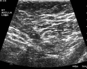 This ultrasound shows a lymph node appearing normal after chemotherapy for breast cancer (Mayo Clinic).