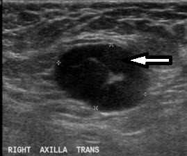This ultrasound shows an abnormal lymph node before chemotherapy for breast cancer. 