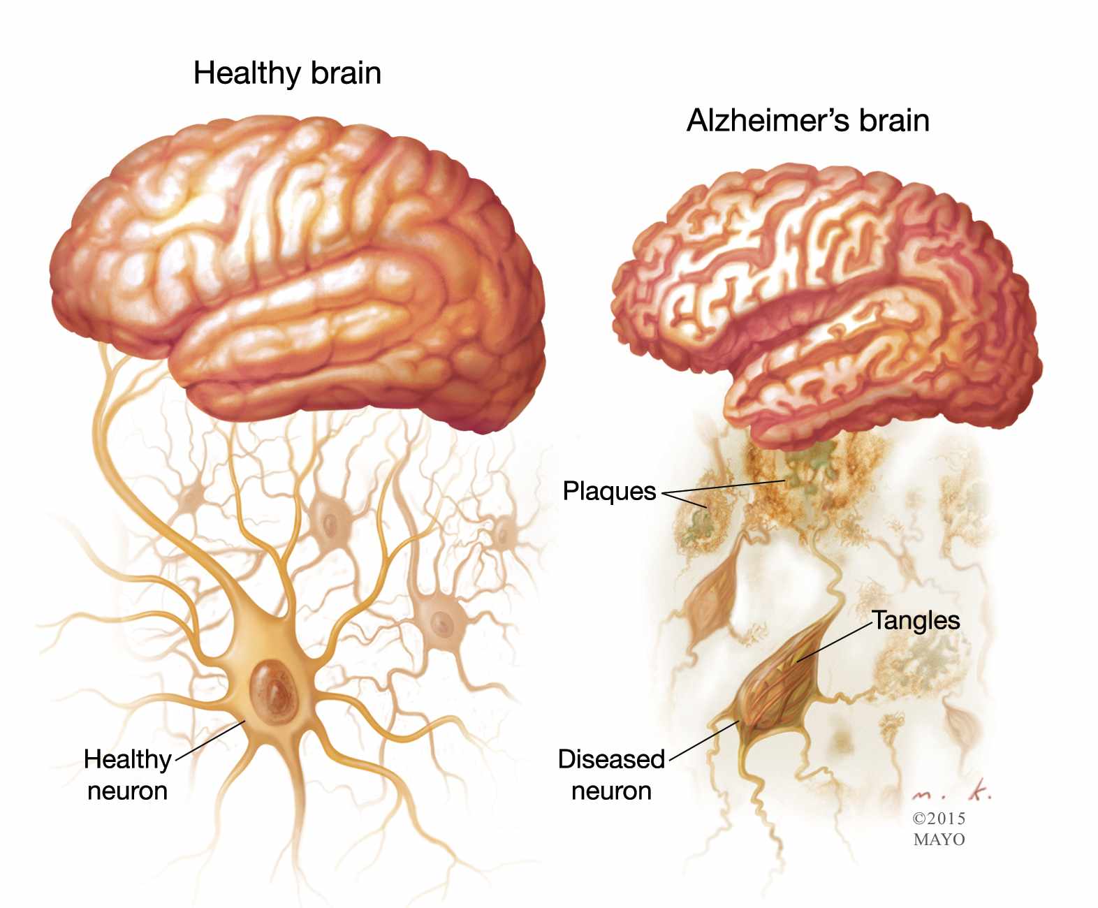 illustration of healthy brain and one with Alzheimer's