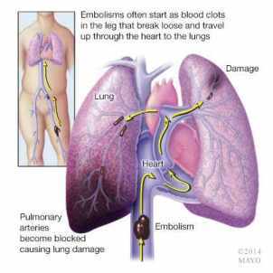 Ilustración de una embolia pulmonar por trombosis venosa profunda