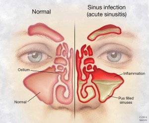 illustration of person's face with sinus infection and inflammation