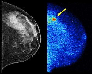 Molecular Breast Imaging (right) detected 3.6 times as many invasive cancers as digital mammography (left) in the latest study of more than 1,500 women with dense breast tissue. Results are published in the American Journal of Roentgenology. 