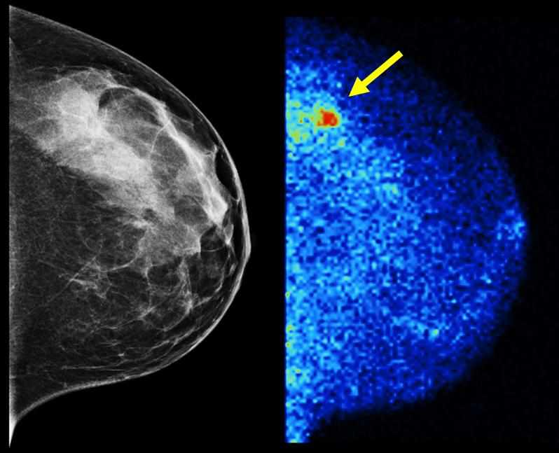 MBI - mammogram Xray