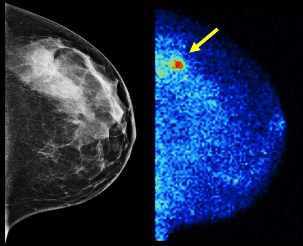 Lado a lado aparece la placa de la mamografía y de las imágenes moleculares de las mamas