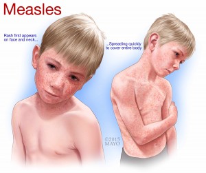 illustration of young boy with measles on his face and body