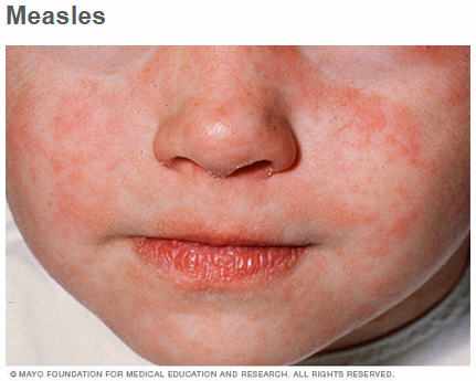 close up of child's face with measles