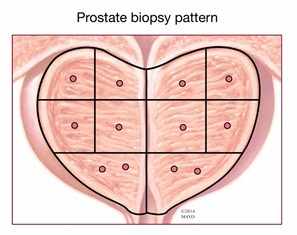 Ilustración de un patrón de biopsia de próstata