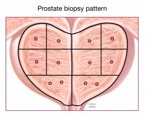 prostate biopsy pattern illustration