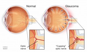 close up illustration of normal eye and glaucoma eye - optic nerves